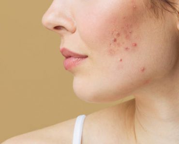 Comment entretenir sa peau quand on a de l’acné ?
